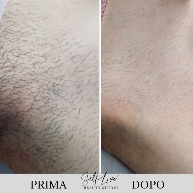 Prima e dopo epilazione laser ascelle