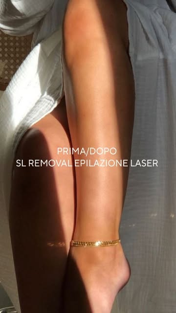 Prima e dopo epilazione laser gambe, metodo SL Removal