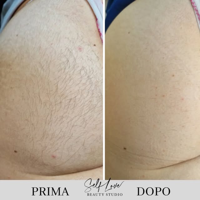 Prima e dopo epilazione laser, risultato SL Removal